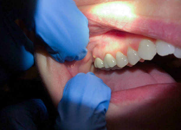 Best Broken or Cracked Tooth Emergency Dentist in Hampton, VA